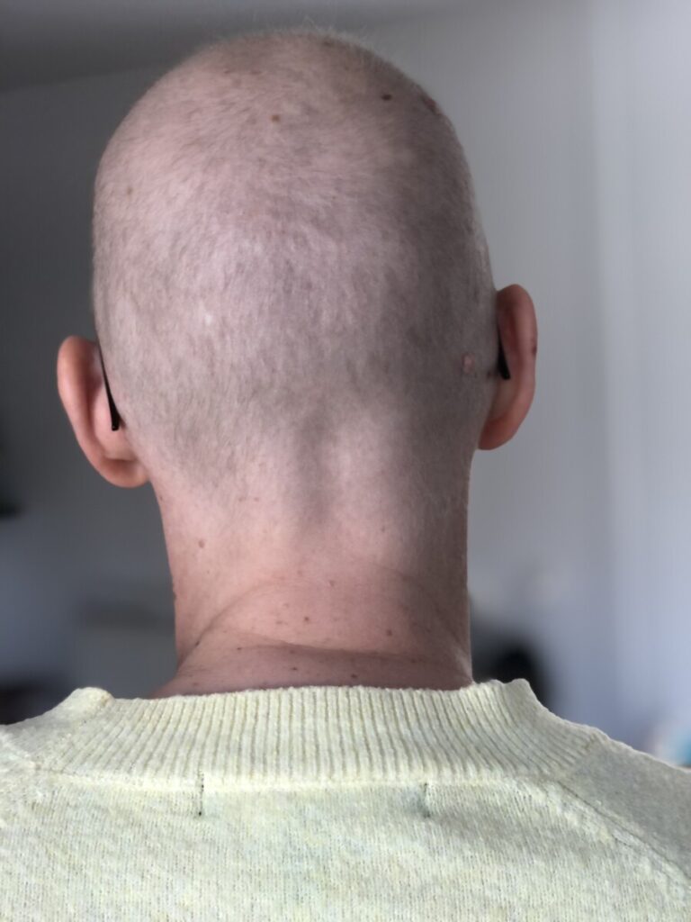 Groeit haar na chemotherapie? Zie hier de eerste babyhaartjes. 